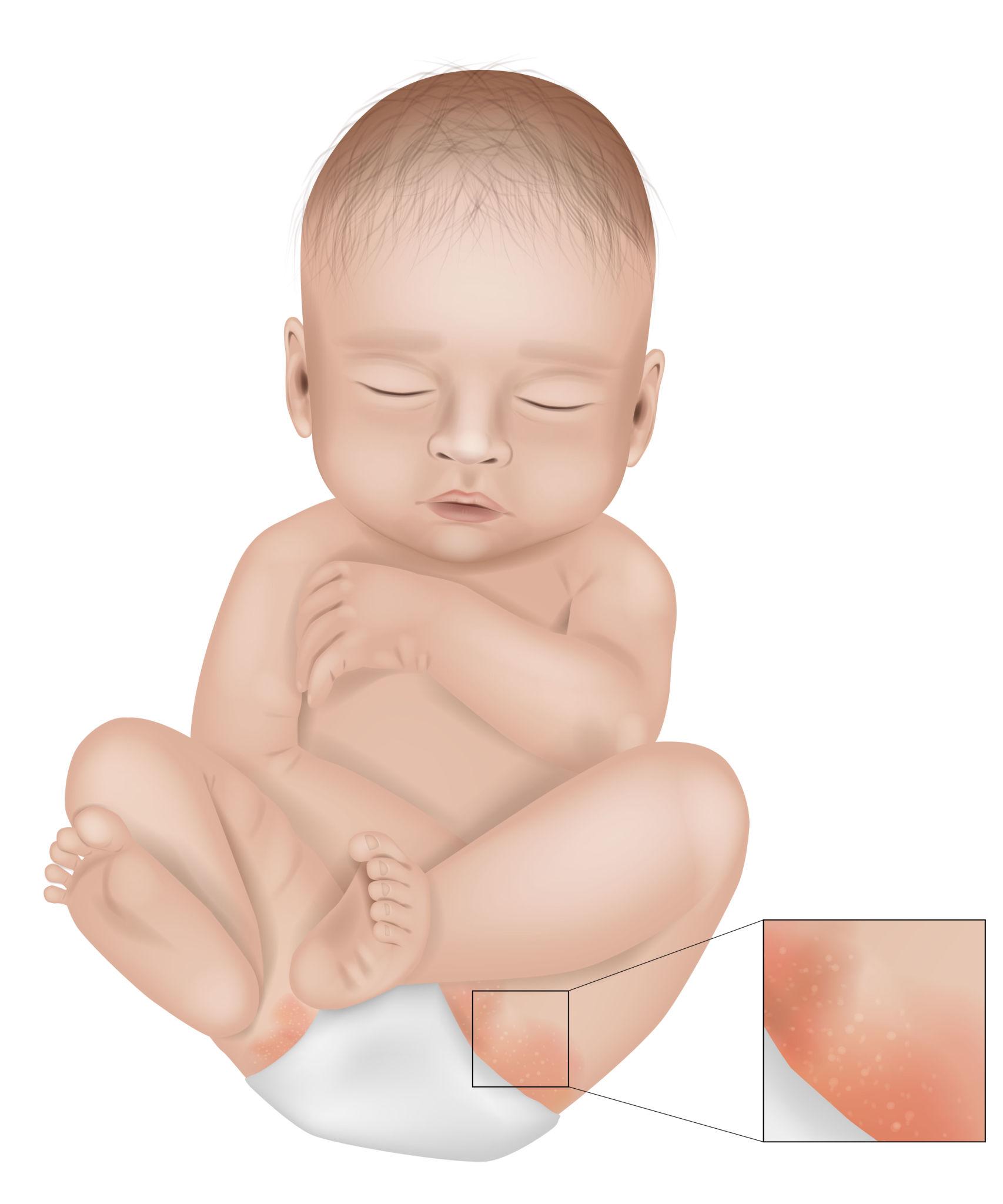 Common signs and symptoms of diaper rash in babies.